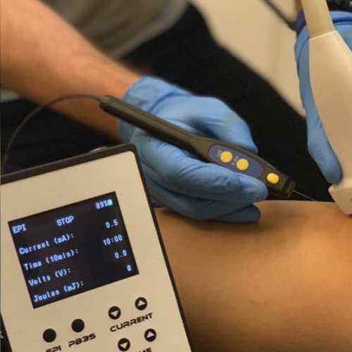 Électrolyse percutanée échoguidée (EPI®) au cabinet PhysioÉvolution — vue 2