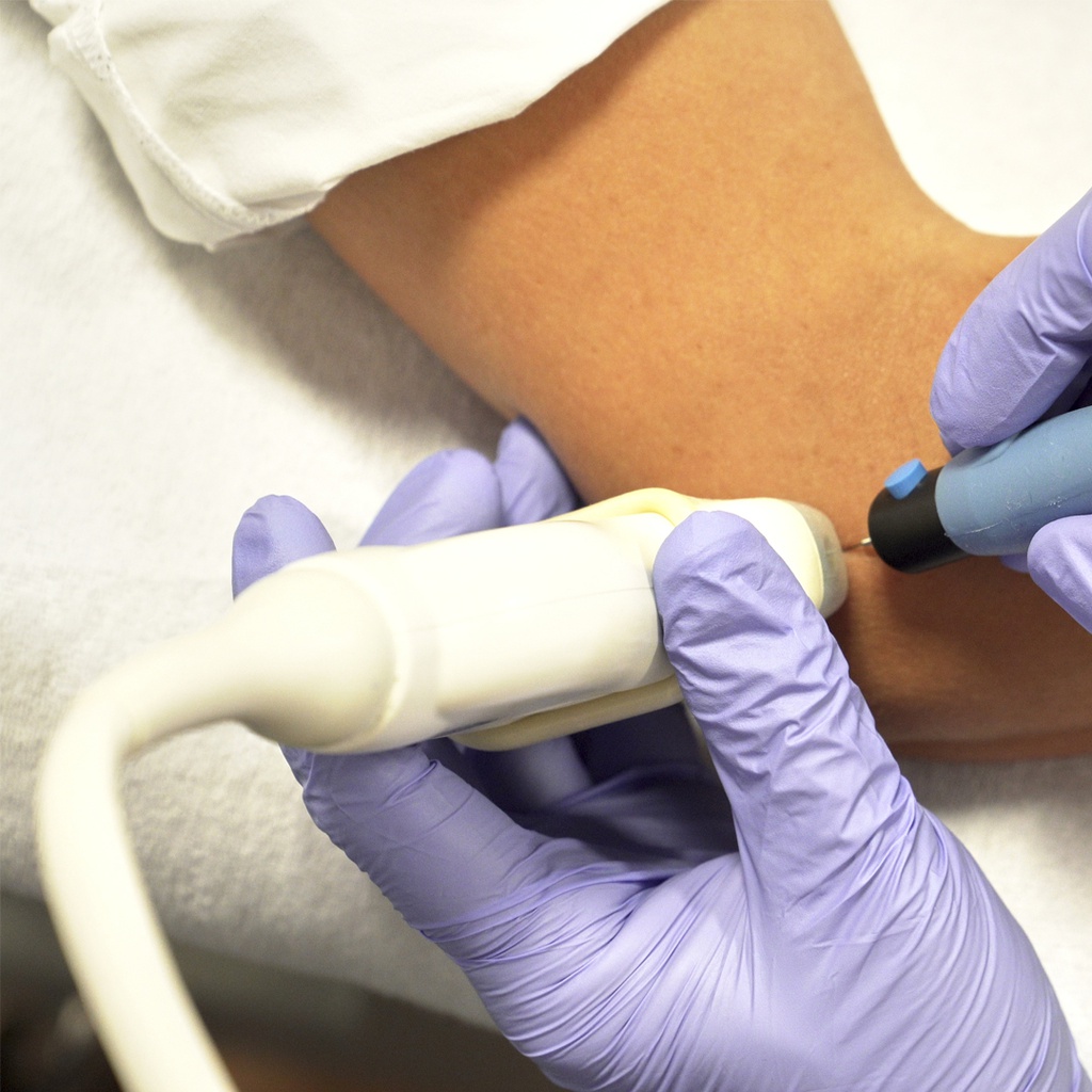 Électrolyse percutanée échoguidée (EPI®) à La Chaux-de-Fonds